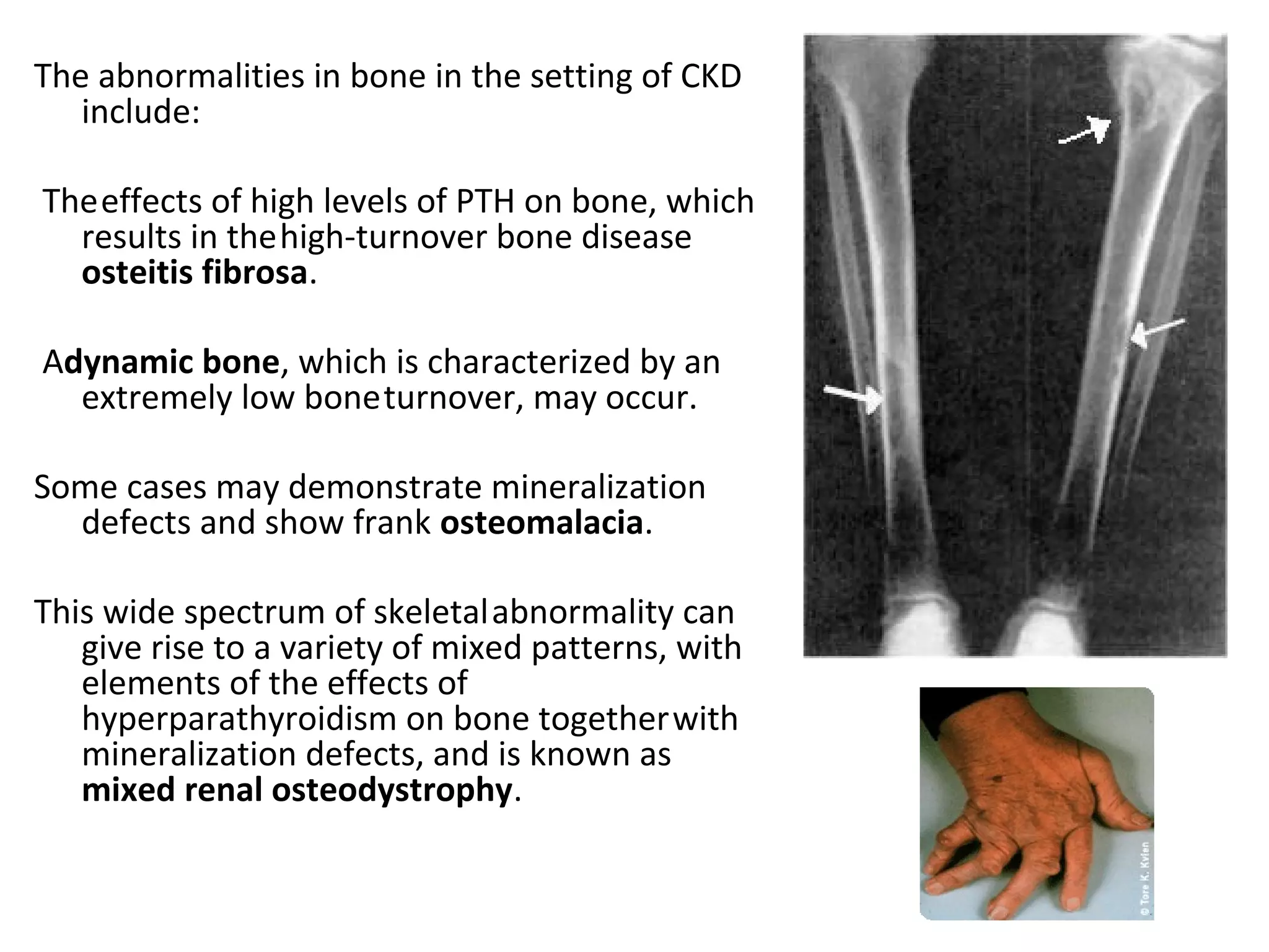 The abnormalities in bone in the setting of CKD
   include:

The effects of high levels of PTH on bone, which
  results in the high-turnover bone disease
  osteitis fibrosa.

Adynamic bone, which is characterized by an
  extremely low bone turnover, may occur.

Some cases may demonstrate mineralization
  defects and show frank osteomalacia.

This wide spectrum of skeletal abnormality can
   give rise to a variety of mixed patterns, with
   elements of the effects of
   hyperparathyroidism on bone together with
   mineralization defects, and is known as
   mixed renal osteodystrophy.
 