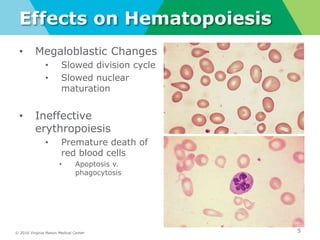 © 2016 Virginia Mason Medical Center
Effects on Hematopoiesis
5
• Megaloblastic Changes
• Slowed division cycle
• Slowed nuclear
maturation
• Ineffective
erythropoiesis
• Premature death of
red blood cells
• Apoptosis v.
phagocytosis
 