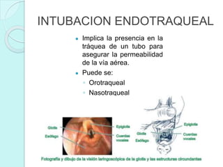 INTUBACIÓN ENDOTRAQUEAL | PPTX