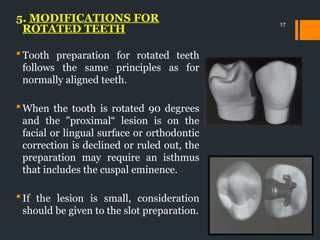 Teeth Modification CL-II CAVITY MODIFICATIONS endodontics .pptx