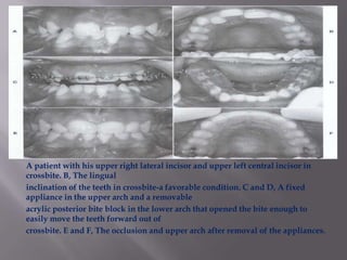 A patient with his upper right lateral incisor and upper left central incisor in
crossbite. B, The lingual
inclination of the teeth in crossbite-a favorable condition. C and D, A fixed
appliance in the upper arch and a removable
acrylic posterior bite block in the lower arch that opened the bite enough to
easily move the teeth forward out of
crossbite. E and F, The occlusion and upper arch after removal of the appliances.
 