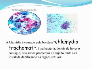 A Clamídia é causado pela bactéria “chlamydia
trachomati”. Essa bactéria, depois de haver o
contágio, cria sérios problemas no sujeito onde está
instalada danificando os órgãos sexuais.
 