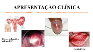 APRESENTAÇÃO CLÍNICA
Doença inflamatória
pélvica (DIP)
Conjutivite
 