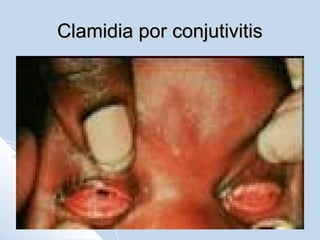 Clamidia por conjutivitis

 