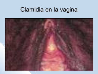 Clamidia en la vagina

 