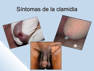 Síntomas de la clamidia

 