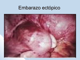 Embarazo ectópico

 