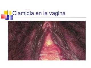 Clamidia en la vagina
 