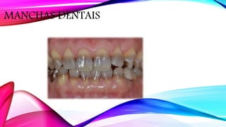 MANCHAS DENTAIS
 