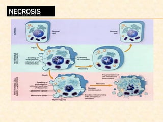 NECROSIS
 