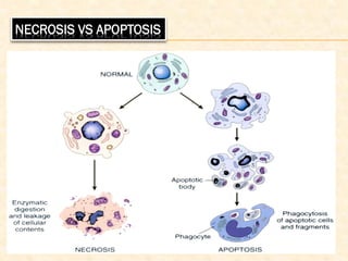 NECROSIS VS APOPTOSIS
 