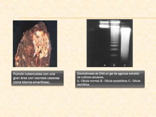 Pulmón tuberculoso con una       Electroforesis de DNA en gel de agarosa extraído
gran área con necrosis caseosa   de cultivos celulares.
(zona blanca-amarillosa).        A.- Célula normal; B.- Célula apoptótica; C.- Célula
                                 necrótica.
 
