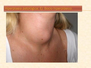 Hiperplasia patológica: Ej: Bocio hiperplásico.
 