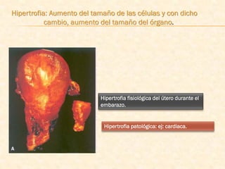 Hipertrofia: Aumento del tamaño de las células y con dicho
           cambio, aumento del tamaño del órgano.




                           Hipertrofia fisiológica del útero durante el
                           embarazo.


                            Hipertrofia patológica: ej: cardiaca.
 