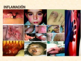INFLAMACIÓN
 