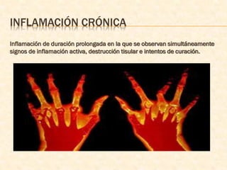 INFLAMACIÓN CRÓNICA
Inflamación de duración prolongada en la que se observan simultáneamente
signos de inflamación activa, destrucción tisular e intentos de curación.
 