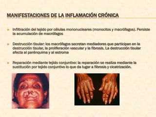 MANIFESTACIONES DE LA INFLAMACIÓN CRÓNICA

   Infiltración del tejido por células mononucleares (monocitos y macrófagos). Persiste
    la acumulación de macrófagos

   Destrucción tisular: los macrófagos secretan mediadores que participan en la
    destrucción tisular, la proliferación vascular y la fibrosis. La destrucción tisular
    afecta al parénquima y al estroma

   Reparación mediante tejido conjuntivo: la reparación se realiza mediante la
    sustitución por tejido conjuntivo lo que da lugar a fibrosis y cicatrización.
 