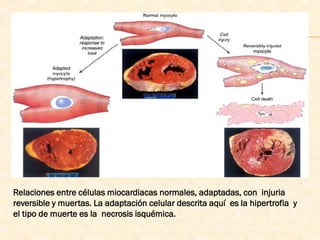 Relaciones entre células miocardiacas normales, adaptadas, con injuria
reversible y muertas. La adaptación celular descrita aquí es la hipertrofia y
el tipo de muerte es la necrosis isquémica.
 