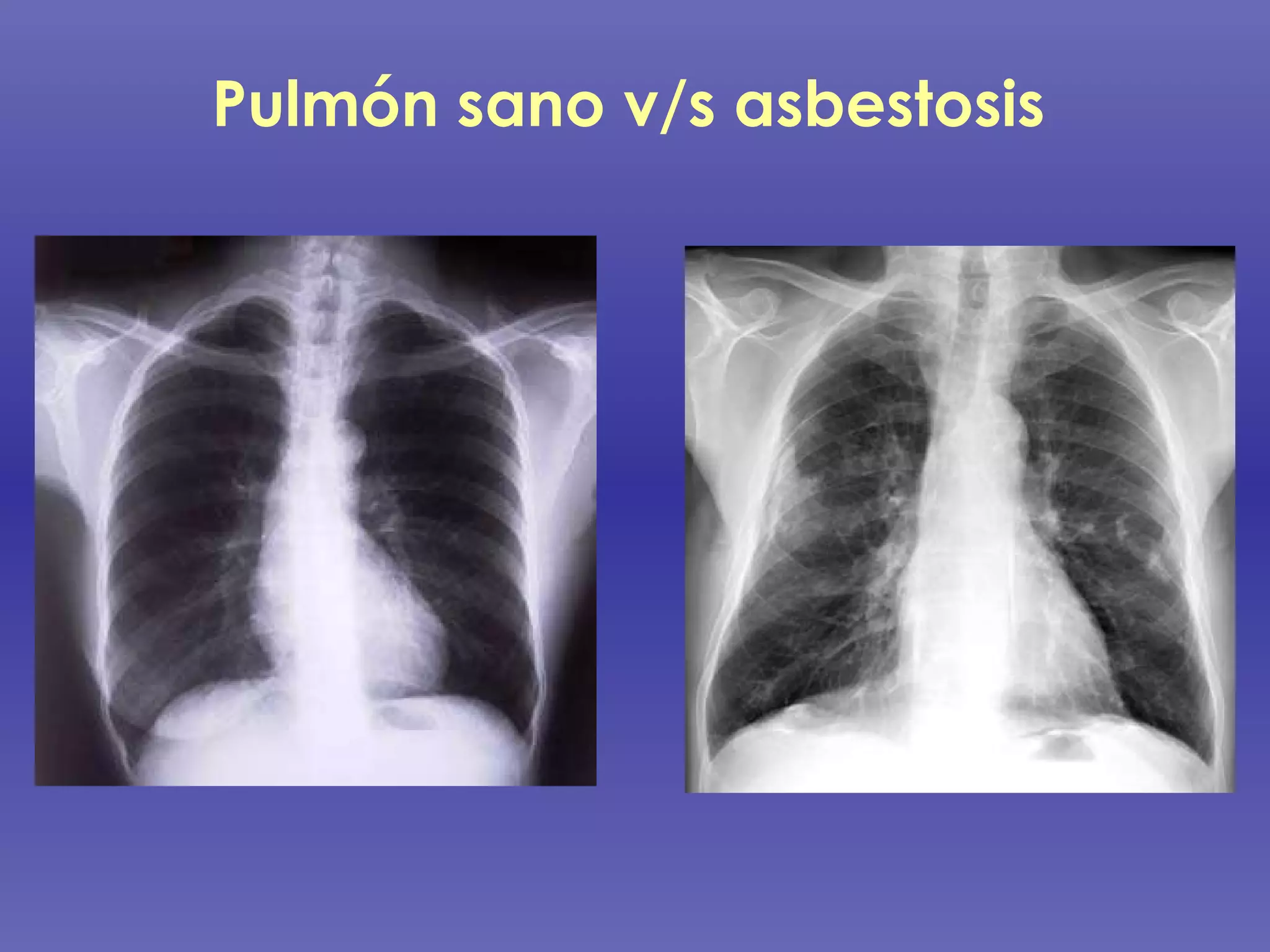 Pulmón sano v/s asbestosis 