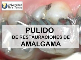 PULIDO   DE RESTAURACIONES DE AMALGAMA 