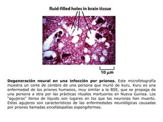 Degeneración neural en una infección por priones.  Este microfotografía muestra un corte de cerebro de una persona que murió de kuru. Kuru es una enfermedad de los priones humanos, muy similar a la BSE, que se propaga de una persona a otra por las prácticas rituales mortuorios en Nueva Guinea. Los “agujeros” llenos de líquido son lugares en los que las neuronas han muerto. Estos agujeros son característicos de las enfermedades neurológicas causadas por priones llamadas encefalopatías espongiformes. 
