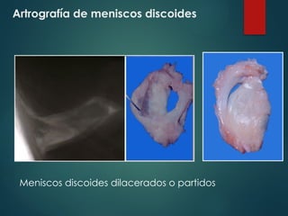 Artrografía de meniscos discoides
Meniscos discoides dilacerados o partidos
 