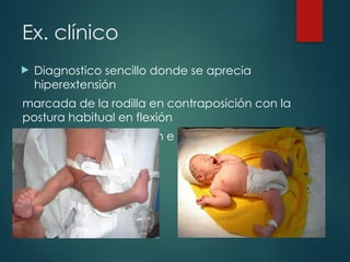 Ex. clínico
 Diagnostico sencillo donde se aprecia
hiperextensión
marcada de la rodilla en contraposición con la
postura habitual en flexión
 Limitación de la flexión e inestabilidad lateral
 