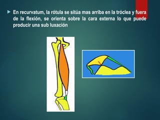  En recurvatum, la rótula se sitúa mas arriba en la tróclea y fuera
de la flexión, se orienta sobre la cara externa lo que puede
producir una sub luxación
 