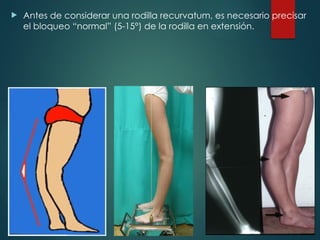  Antes de considerar una rodilla recurvatum, es necesario precisar
el bloqueo “normal” (5-15°) de la rodilla en extensión.
 