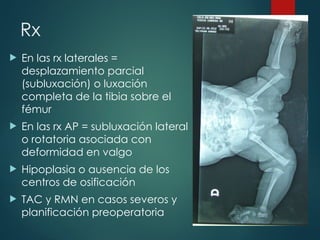 Rx
 En las rx laterales =
desplazamiento parcial
(subluxación) o luxación
completa de la tibia sobre el
fémur
 En las rx AP = subluxación lateral
o rotatoria asociada con
deformidad en valgo
 Hipoplasia o ausencia de los
centros de osificación
 TAC y RMN en casos severos y
planificación preoperatoria
 