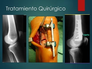 Tratamiento Quirúrgico
 