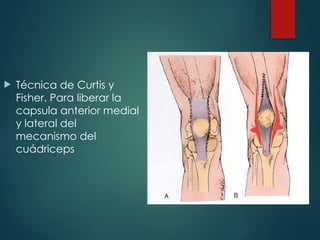  Técnica de Curtis y
Fisher. Para liberar la
capsula anterior medial
y lateral del
mecanismo del
cuádriceps
 