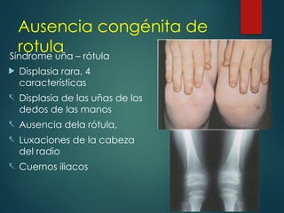 Ausencia congénita de
rotula
Síndrome uña – rótula
 Displasia rara, 4
características
- Displasia de las uñas de los
dedos de las manos
- Ausencia dela rótula,
- Luxaciones de la cabeza
del radio
- Cuernos iliacos
 