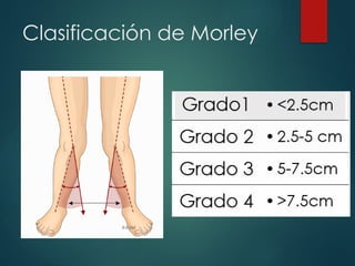 Clasificación de Morley
 