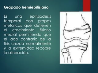 Grapado hemiepifisiario
Es una epifisiodesis
temporal con grapas
metálicas que detienen
el crecimiento fisiario
medial permitiendo que
el lado contrario de la
fisis crezca normalmente
y la extremidad recobre
la alineación.
 