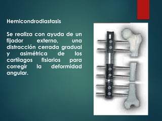 Hemicondrodiastasis
Se realiza con ayuda de un
fijador externo, una
distracción cerrada gradual
y asimétrica de los
cartílagos fisiarios para
corregir la deformidad
angular.
 
