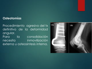 Osteotomías
Procedimiento agresivo del tx
definitivo de la deformidad
angular.
Para la consolidación
necesita inmovilización
externa u osteosintesis interna.
 