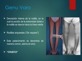Genu Varo
 Desviación interna de la rodilla, en la
cual la porción de la extremidad distal a
la rodilla se desvía hacia la línea media
 Rodillas arqueadas (“De vaquero”)
 Este padecimiento se denomina de
manera común, pierna en arco.
 “CHUECO”
 