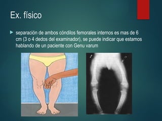 Ex. físico
 separación de ambos cóndilos femorales internos es mas de 6
cm (3 o 4 dedos del examinador), se puede indicar que estamos
hablando de un paciente con Genu varum
 
