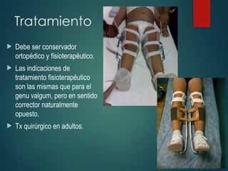 Tratamiento
 Debe ser conservador
ortopédico y fisioterapéutico.
 Las indicaciones de
tratamiento fisioterapéutico
son las mismas que para el
genu valgum, pero en sentido
corrector naturalmente
opuesto.
 Tx quirúrgico en adultos.
 