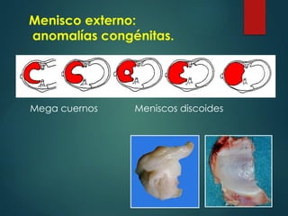Menisco externo:
anomalías congénitas.
Mega cuernos Meniscos discoides
 