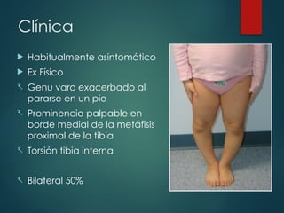 Clínica
 Habitualmente asintomático
 Ex Físico
- Genu varo exacerbado al
pararse en un pie
- Prominencia palpable en
borde medial de la metáfisis
proximal de la tibia
- Torsión tibia interna
- Bilateral 50%
 