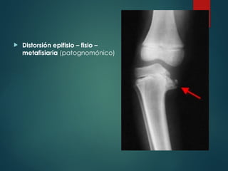  Distorsión epifisio – fisio –
metafisiaria (patognomónico)
 