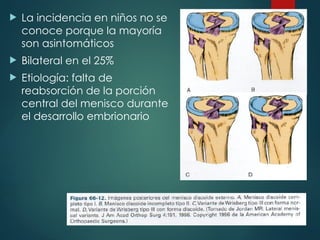 La incidencia en niños no se
conoce porque la mayoría
son asintomáticos
 Bilateral en el 25%
 Etiología: falta de
reabsorción de la porción
central del menisco durante
el desarrollo embrionario
 