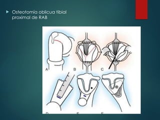  Osteotomía oblicua tibial
proximal de RAB
 