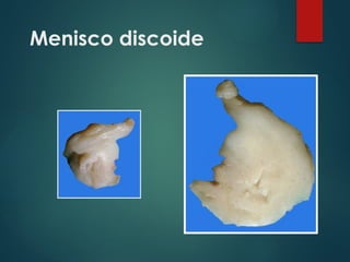 Menisco discoide
 