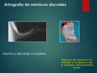 Artrografía de meniscos discoides
Menisco discoide completo
Resección del menisco en su
totalidad, en la época en que
se realizaban meniscectomías
totales
 