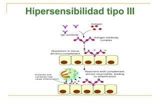 Hipersensibilidad tipo III
 