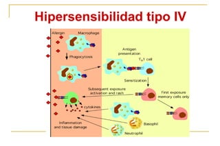 Hipersensibilidad tipo IV
 