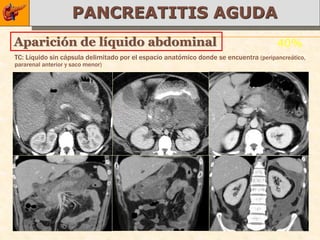 PANCREATITIS AGUDA
Aparición de líquido abdominal                                                        40%
TC: Líquido sin cápsula delimitado por el espacio anatómico donde se encuentra (peripancreático,
pararenal anterior y saco menor)
 